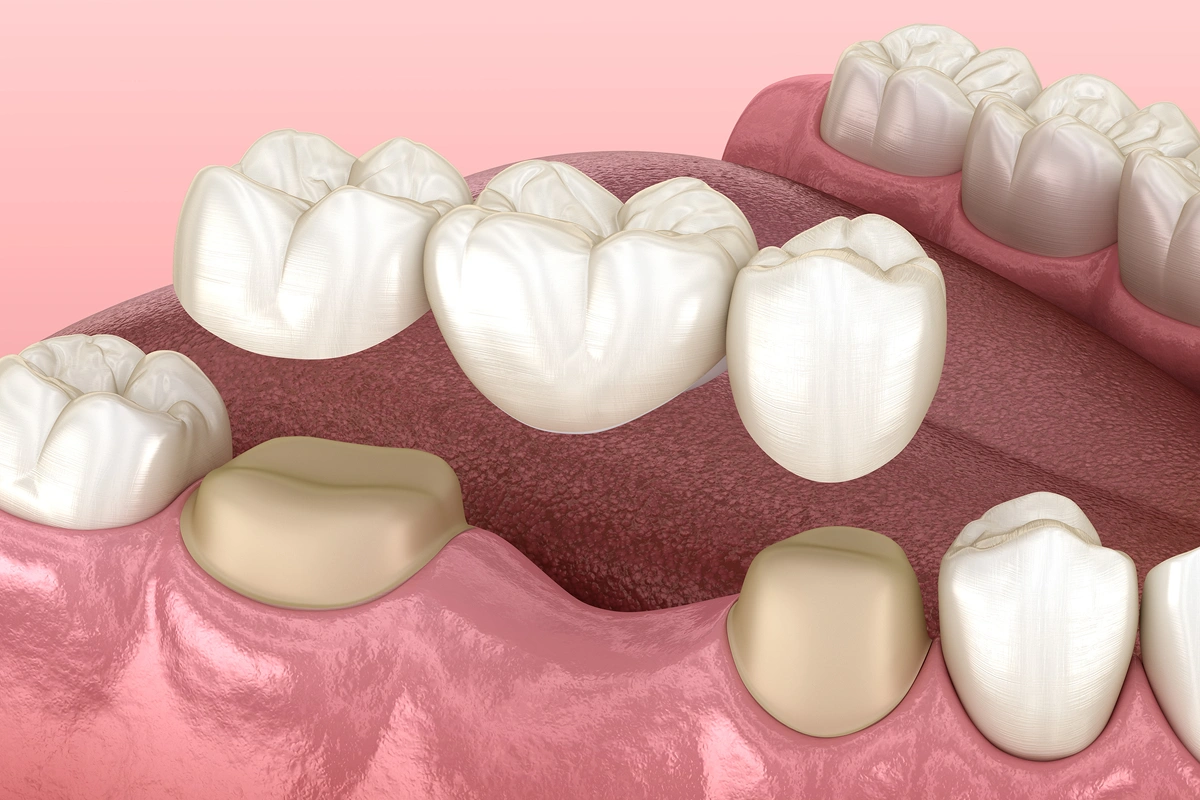 four-types-of-dental-bridges
