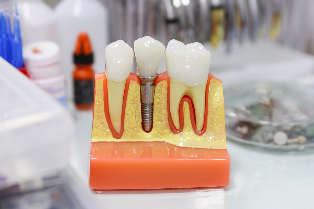 why-dental-implants-are-the-best-solution-for-missing-teeth-in-henderson