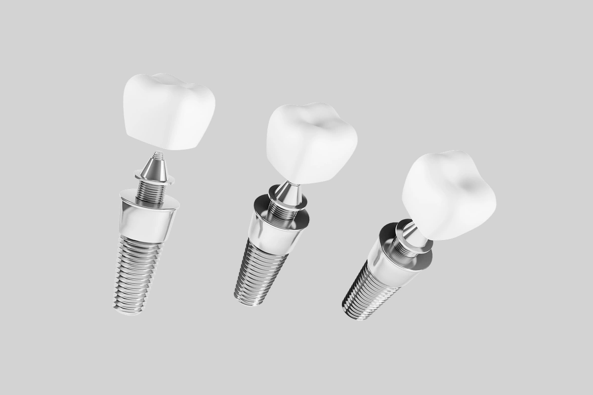 implant-dentistry-bridge-for-jawbone-loss-and-missing-teeth