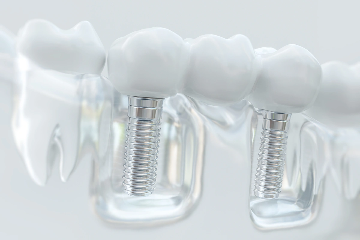 single-tooth-or-multiple-teeth-replacement-which-option-is-right-for-you
