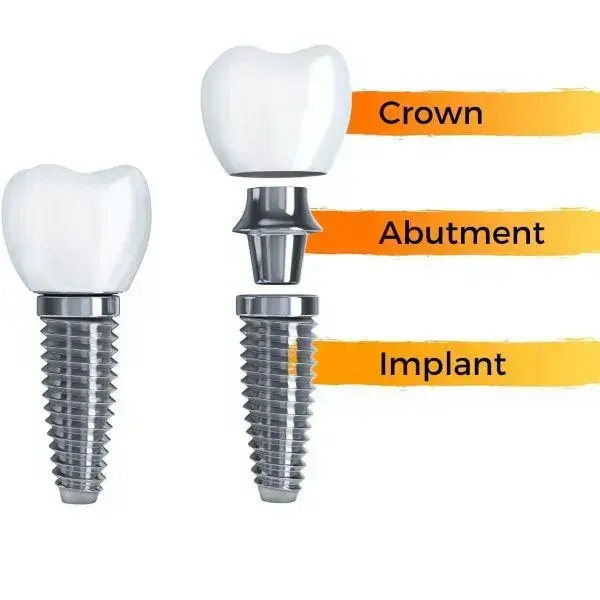 Dental implant diagram showing crown, abutment, and implant components side by side.