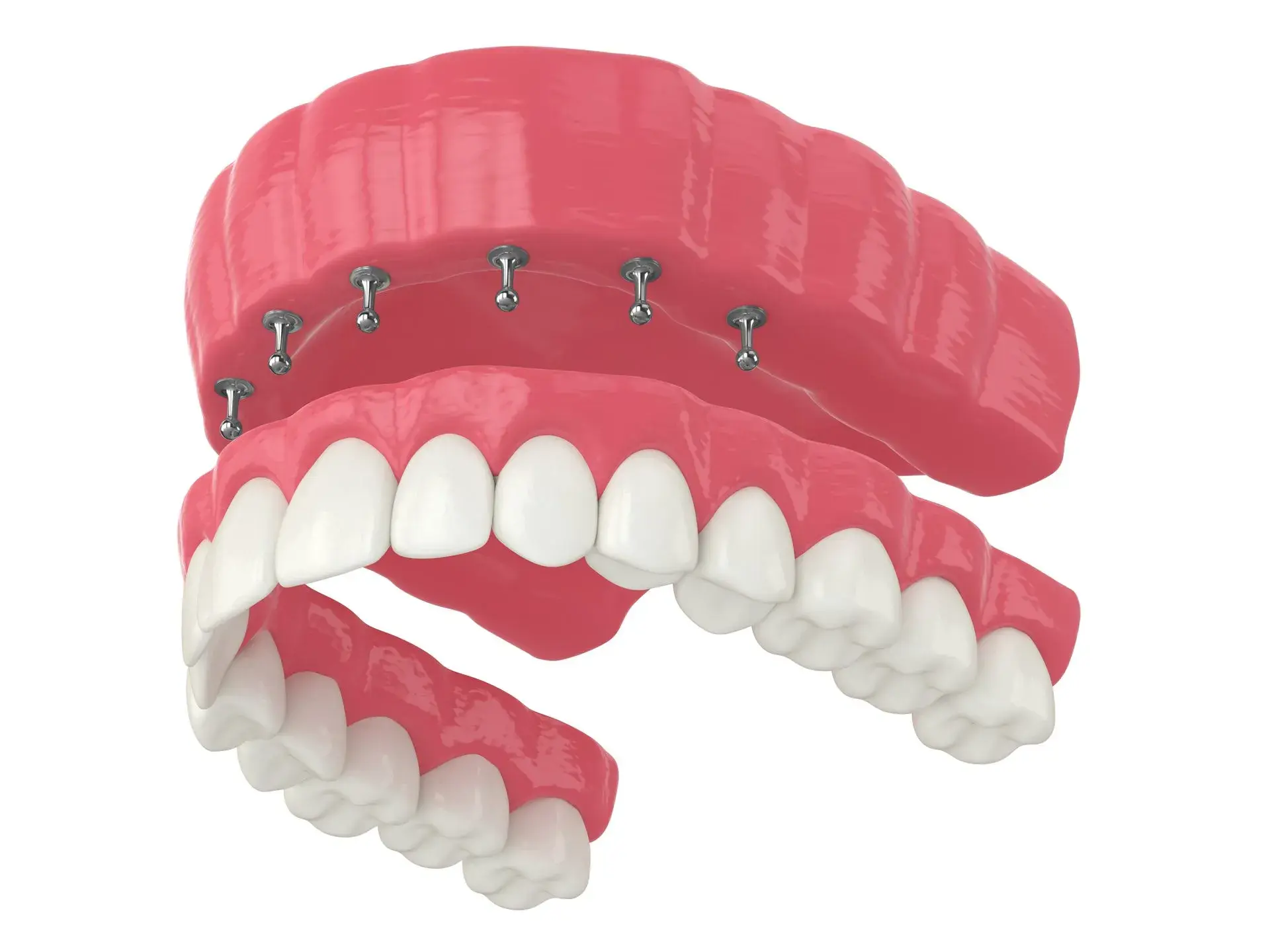 All-on-6 dental implant restoration showing six titanium implants supporting upper teeth prosthesis.