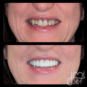 Before and after dental treatment results for a patient at Joshua M. Ignatowicz DMD & Associates