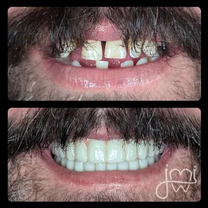 Before and after dental treatment results for a patient at Joshua M. Ignatowicz DMD & Associates