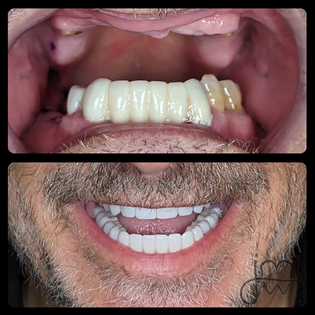 Before and after dental treatment results for a patient at Joshua M. Ignatowicz DMD & Associates
