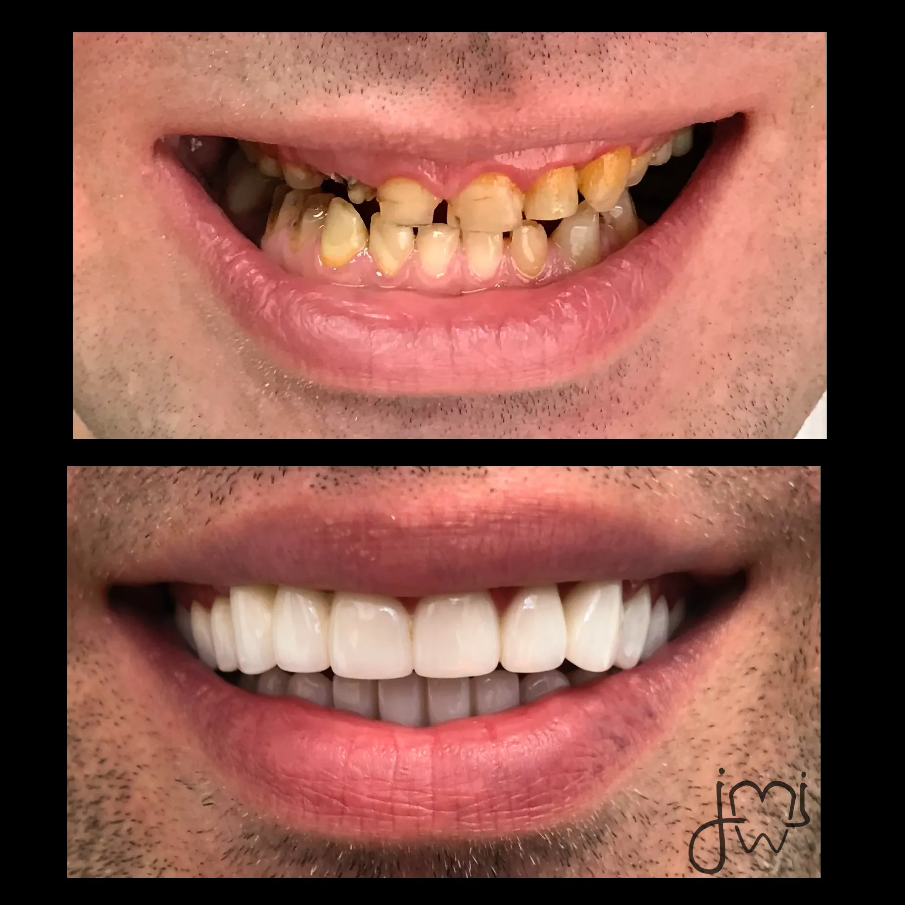 Before and after dental treatment results for a patient at Joshua M. Ignatowicz DMD & Associates