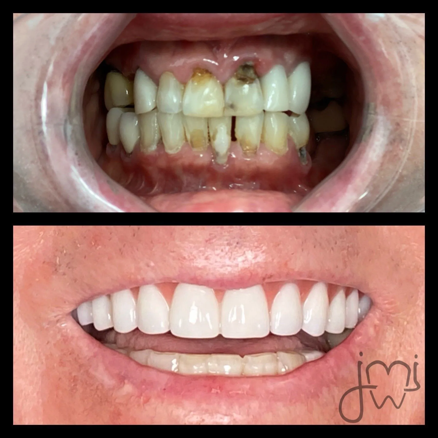 Before and after dental treatment results for a patient at Joshua M. Ignatowicz DMD & Associates