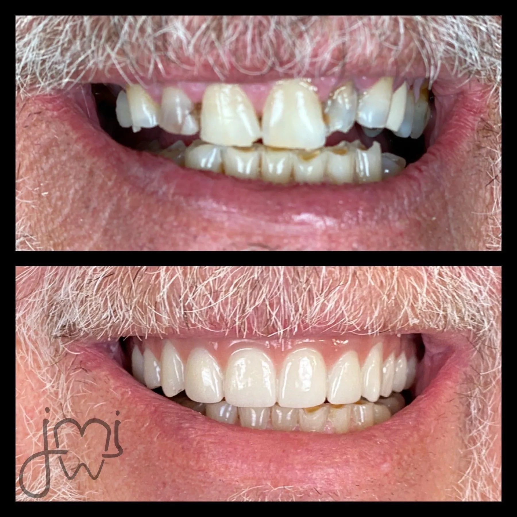 Before and after dental treatment results for a patient at Joshua M. Ignatowicz DMD & Associates