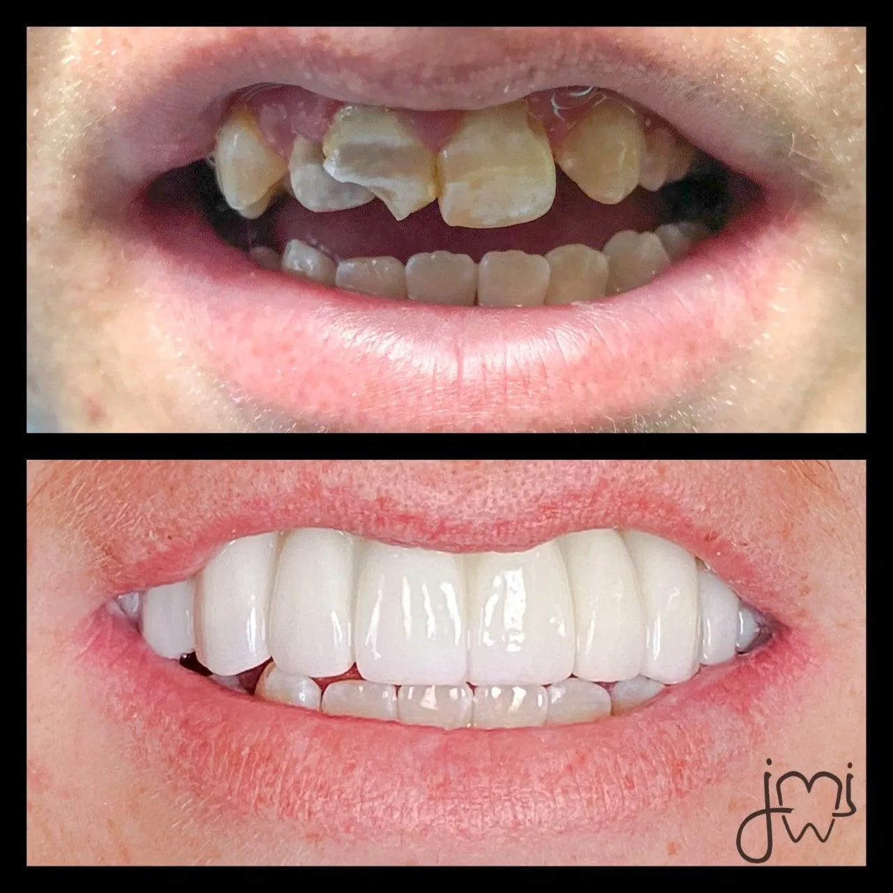 Before and after dental treatment results for a patient at Joshua M. Ignatowicz DMD & Associates