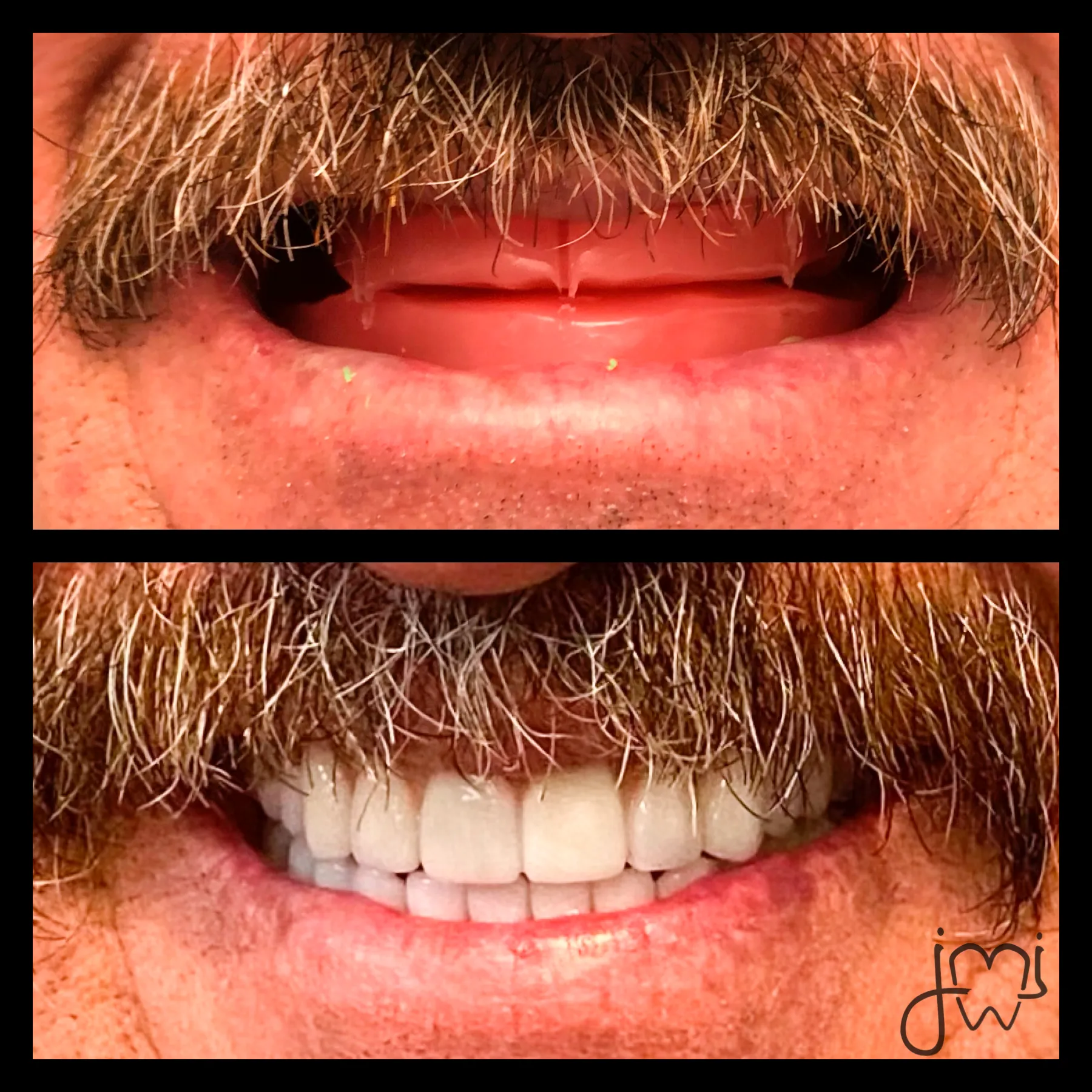 Before and after dental treatment results for a patient at Joshua M. Ignatowicz DMD & Associates