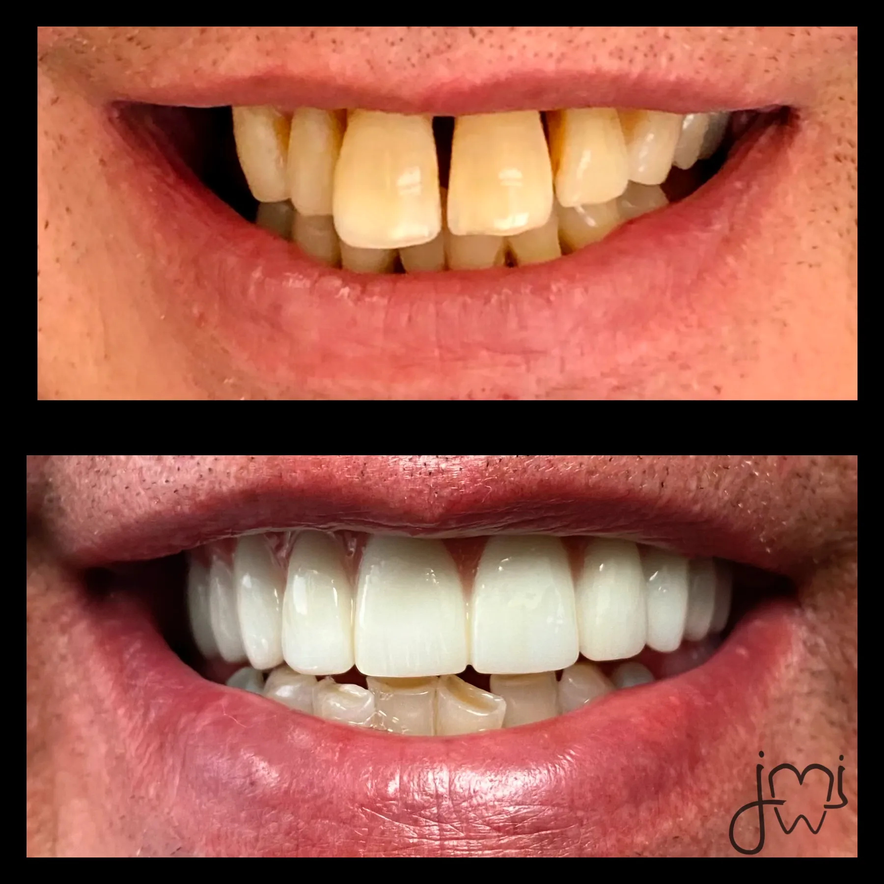Before and after dental treatment results for a patient at Joshua M. Ignatowicz DMD & Associates