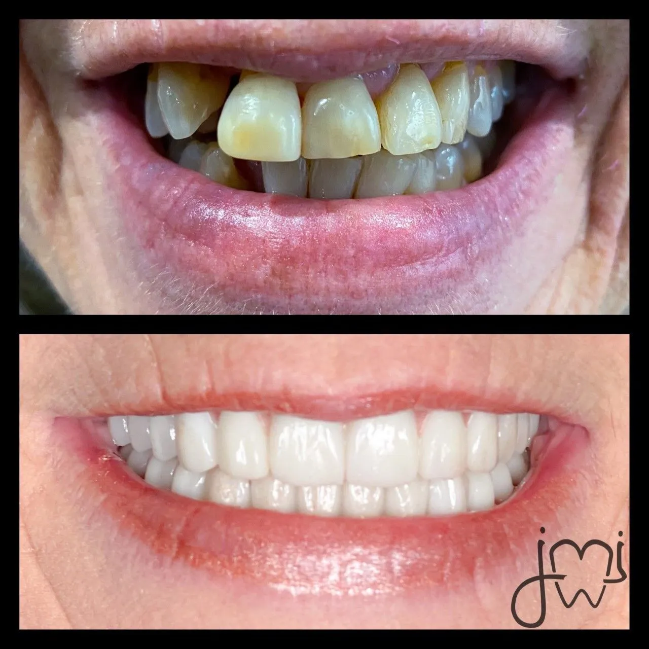 Before and after dental treatment results for a patient at Joshua M. Ignatowicz DMD & Associates