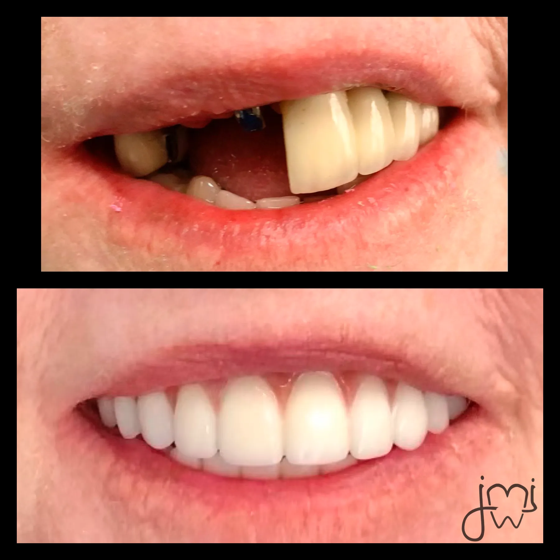 Before and after dental treatment results for a patient at Joshua M. Ignatowicz DMD & Associates
