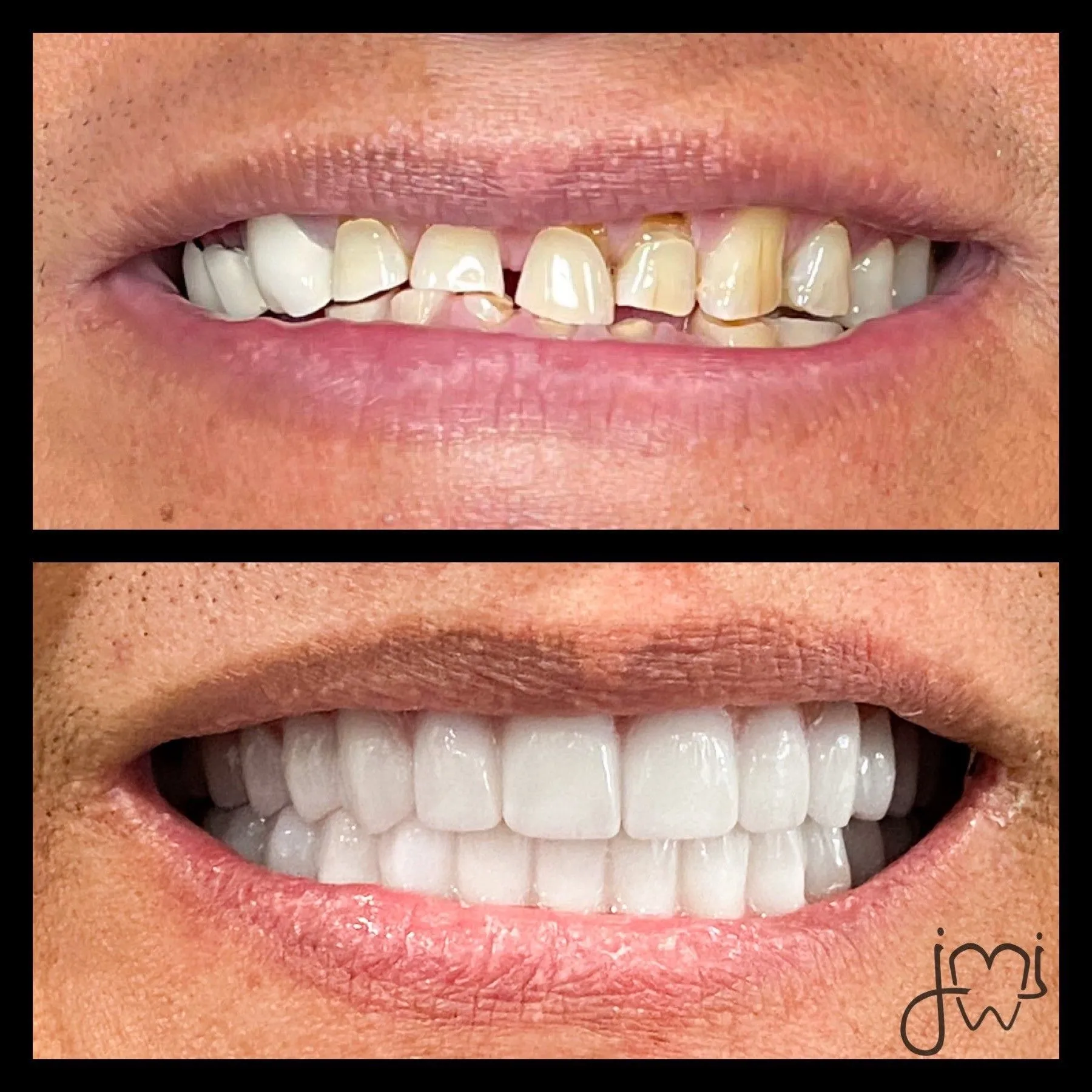 Before and after dental treatment results for a patient at Joshua M. Ignatowicz DMD & Associates