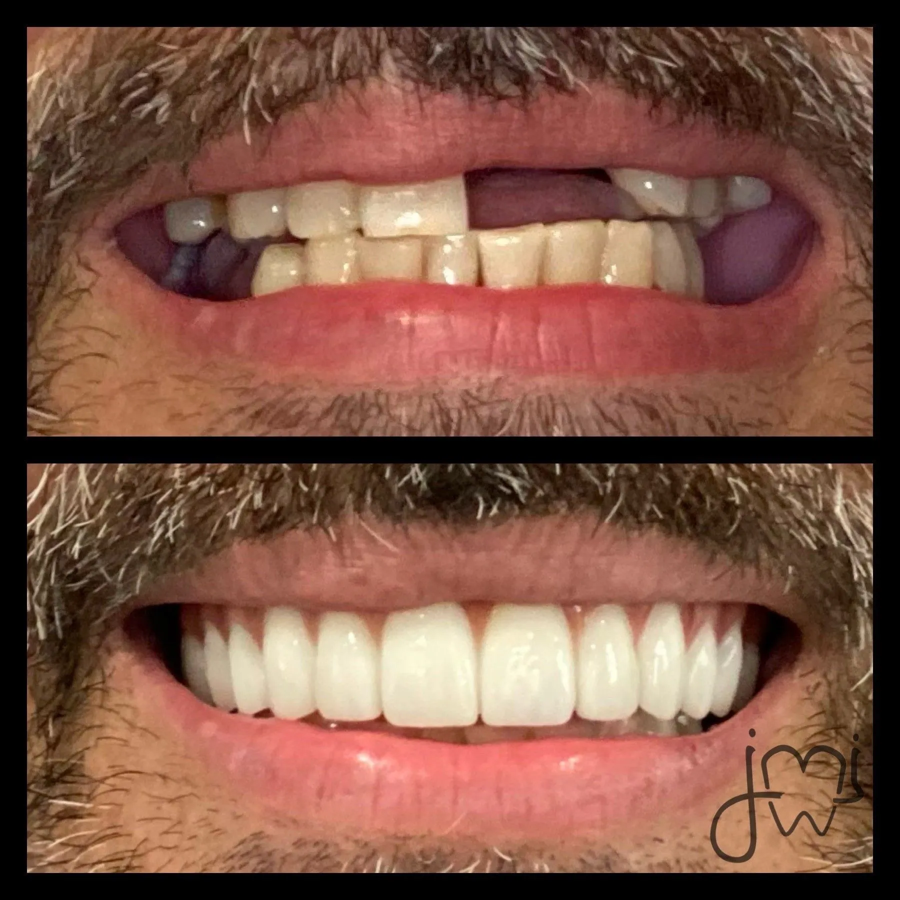 Before and after dental treatment results for a patient at Joshua M. Ignatowicz DMD & Associates
