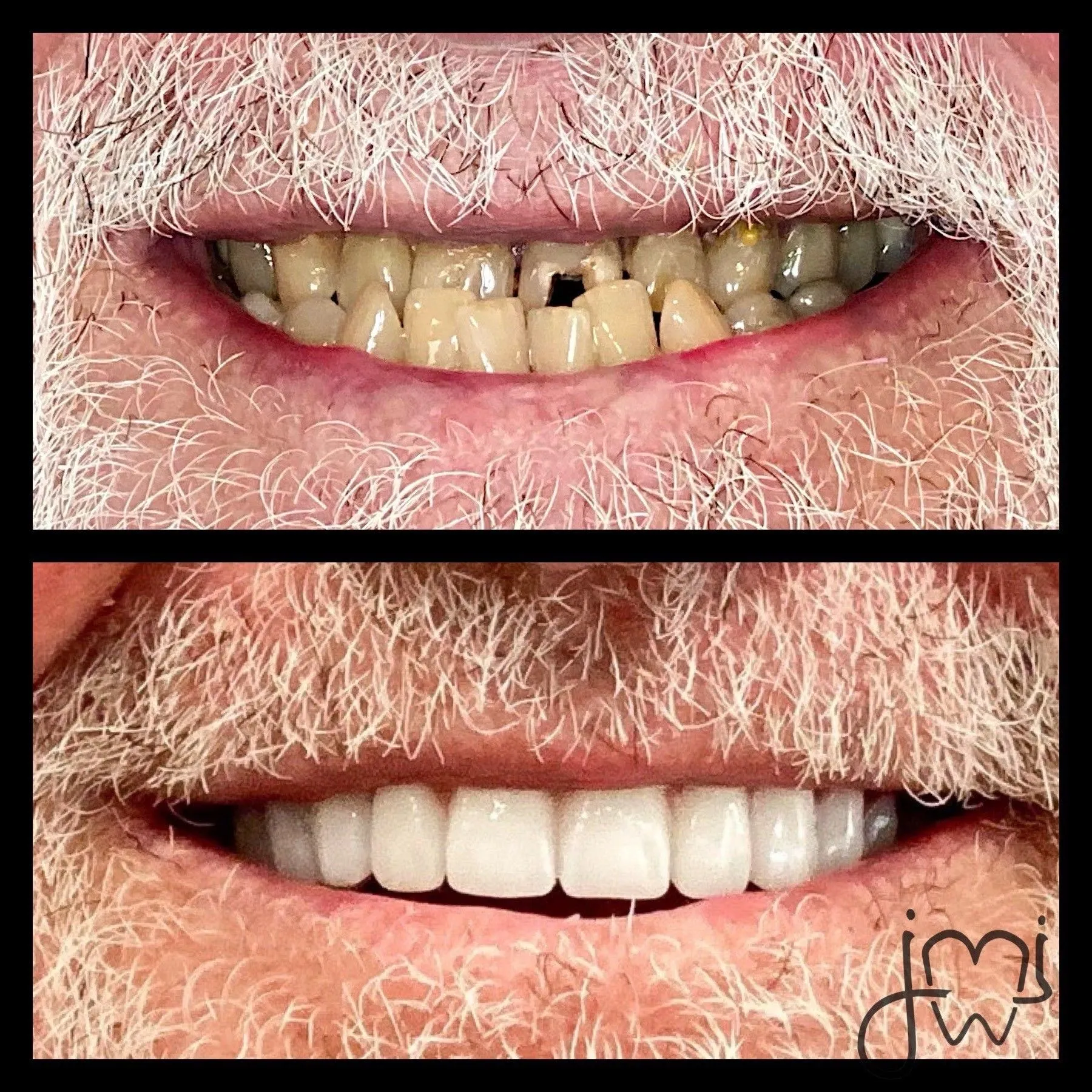 Before and after dental treatment results for a patient at Joshua M. Ignatowicz DMD & Associates