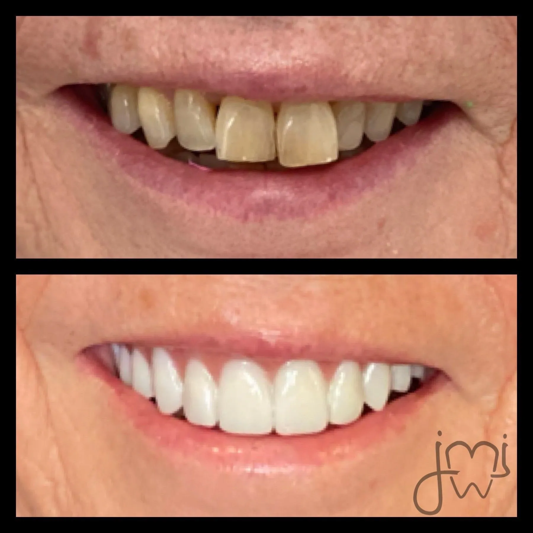 Before and after dental treatment results for a patient at Joshua M. Ignatowicz DMD & Associates