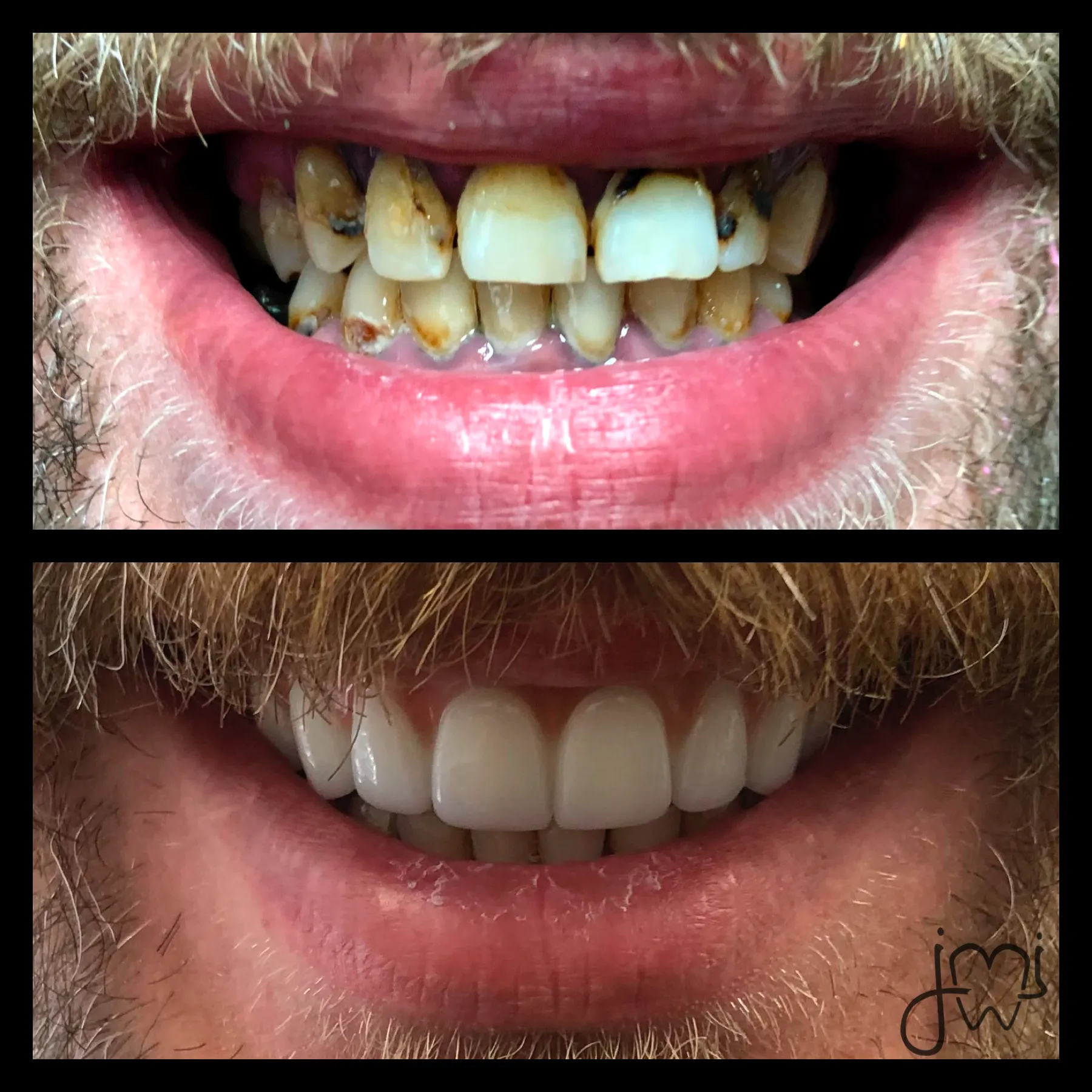 Before and after dental treatment results for a patient at Joshua M. Ignatowicz DMD & Associates