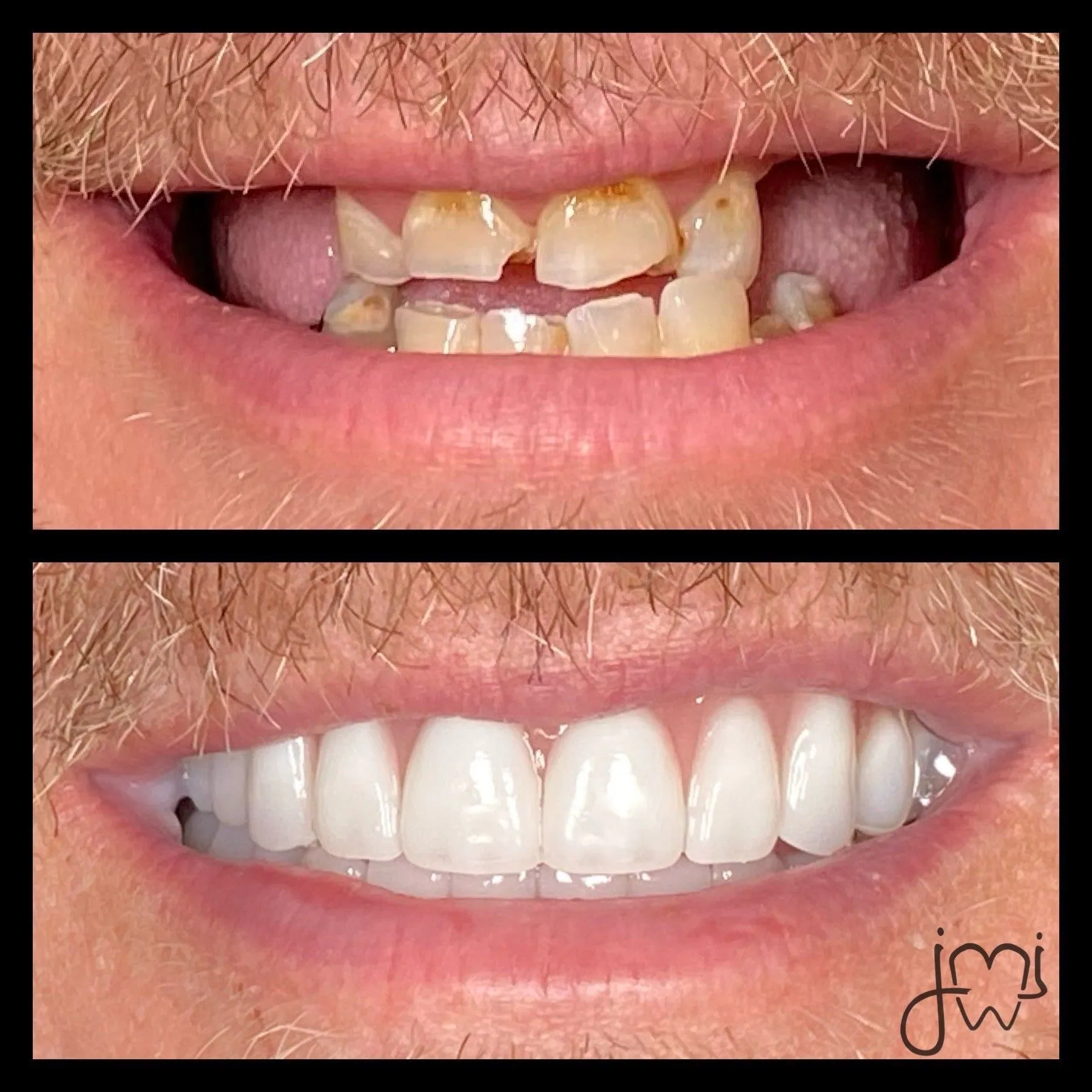Before and after dental treatment results for a patient at Joshua M. Ignatowicz DMD & Associates