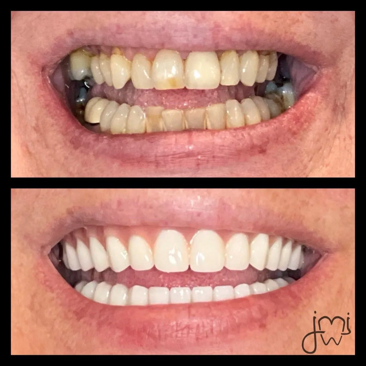 Before and after dental treatment results for a patient at Joshua M. Ignatowicz DMD & Associates