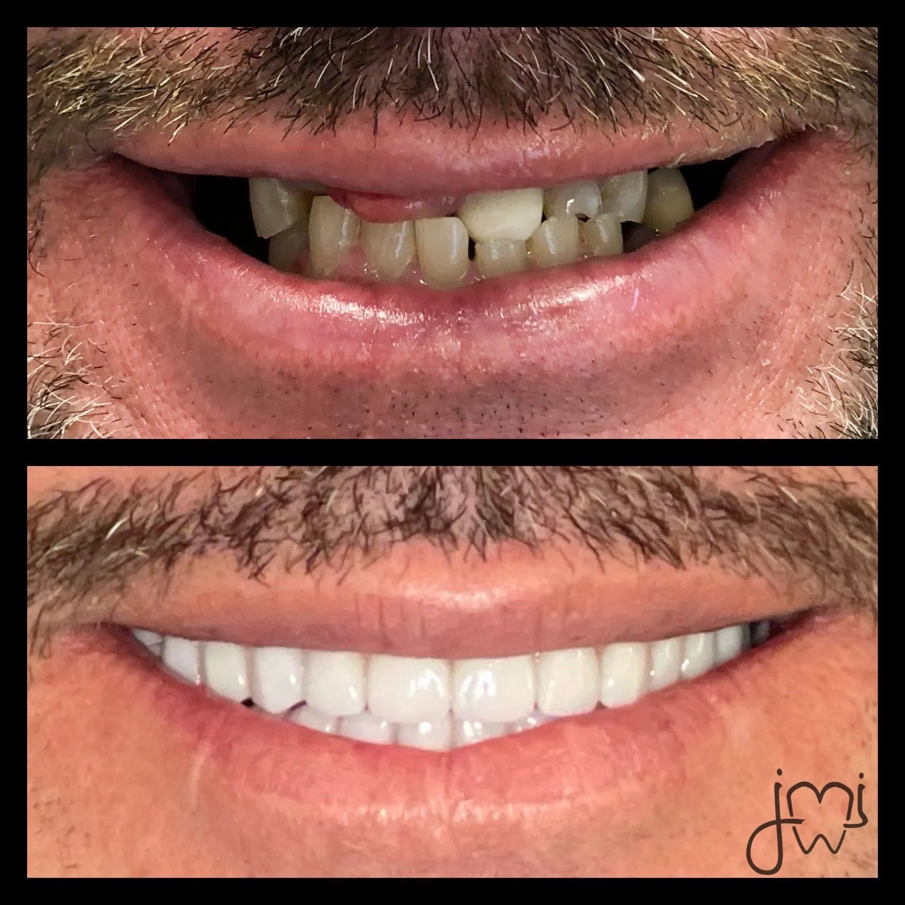 Before and after dental treatment results for a patient at Joshua M. Ignatowicz DMD & Associates