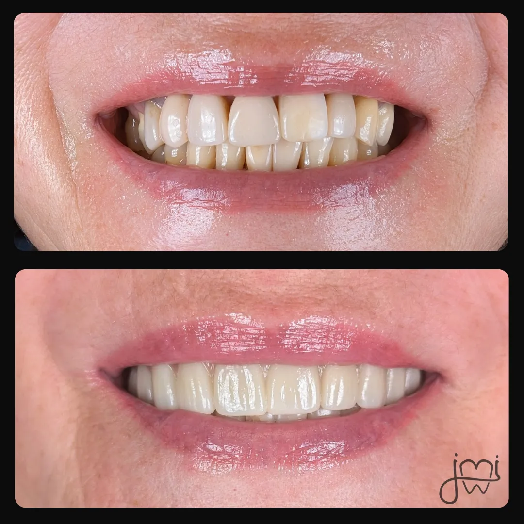 Before and after dental treatment results for a patient at Joshua M. Ignatowicz DMD & Associates