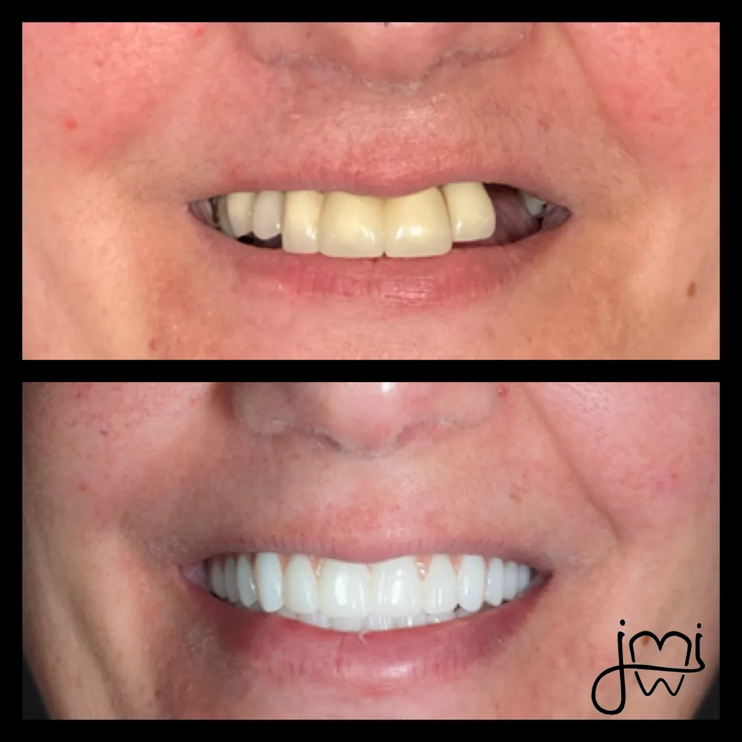 Before and after dental treatment results for a patient at Joshua M. Ignatowicz DMD & Associates