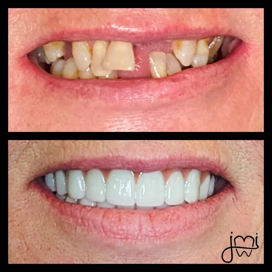 Before and after dental treatment results for a patient at Joshua M. Ignatowicz DMD & Associates