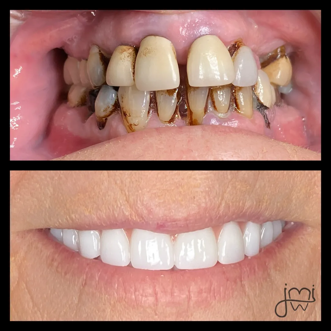Before and after dental treatment results for a patient at Joshua M. Ignatowicz DMD & Associates