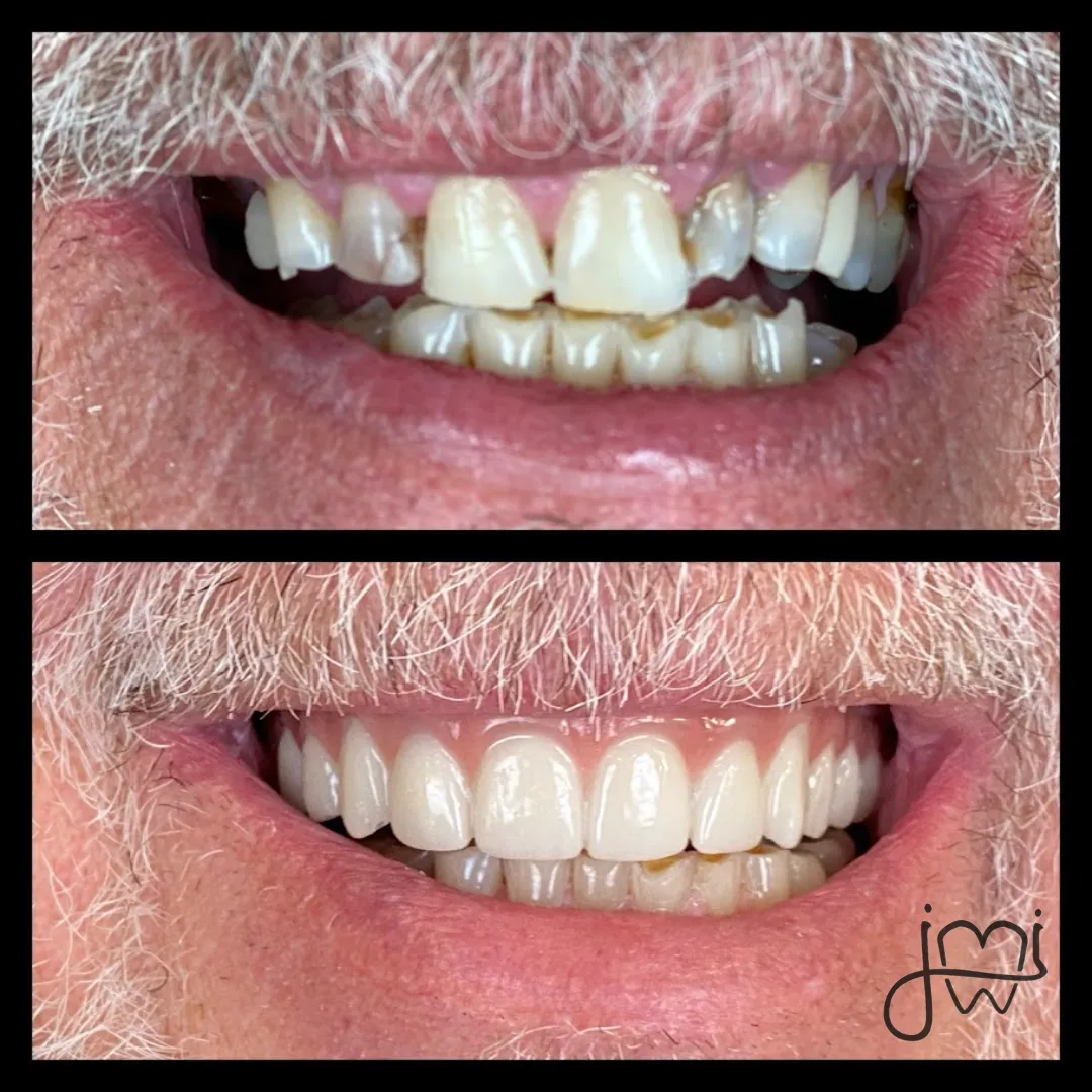 Before and after dental treatment results for a patient at Joshua M. Ignatowicz DMD & Associates