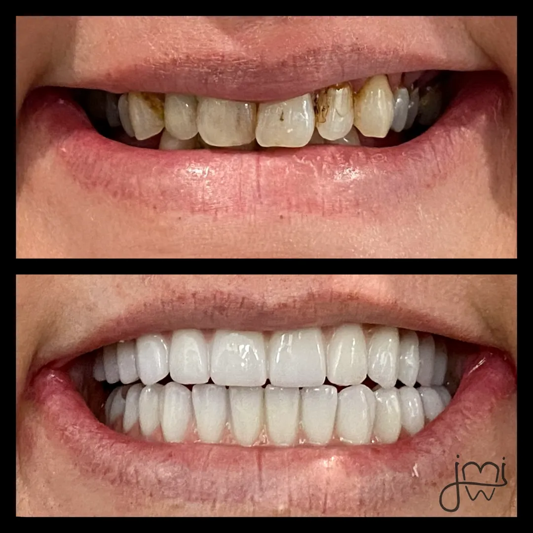 Before and after dental treatment results for a patient at Joshua M. Ignatowicz DMD & Associates