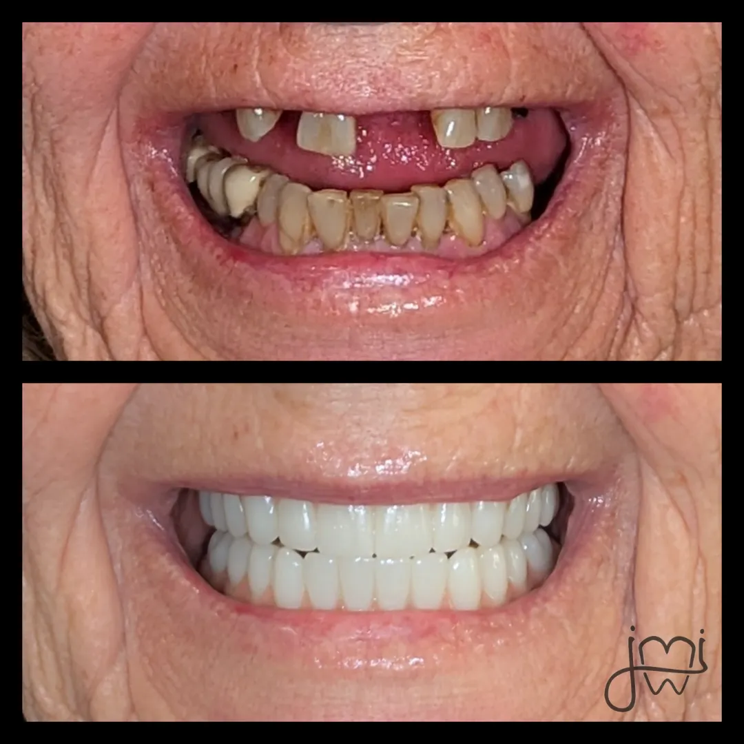 Before and after dental treatment results for a patient at Joshua M. Ignatowicz DMD & Associates