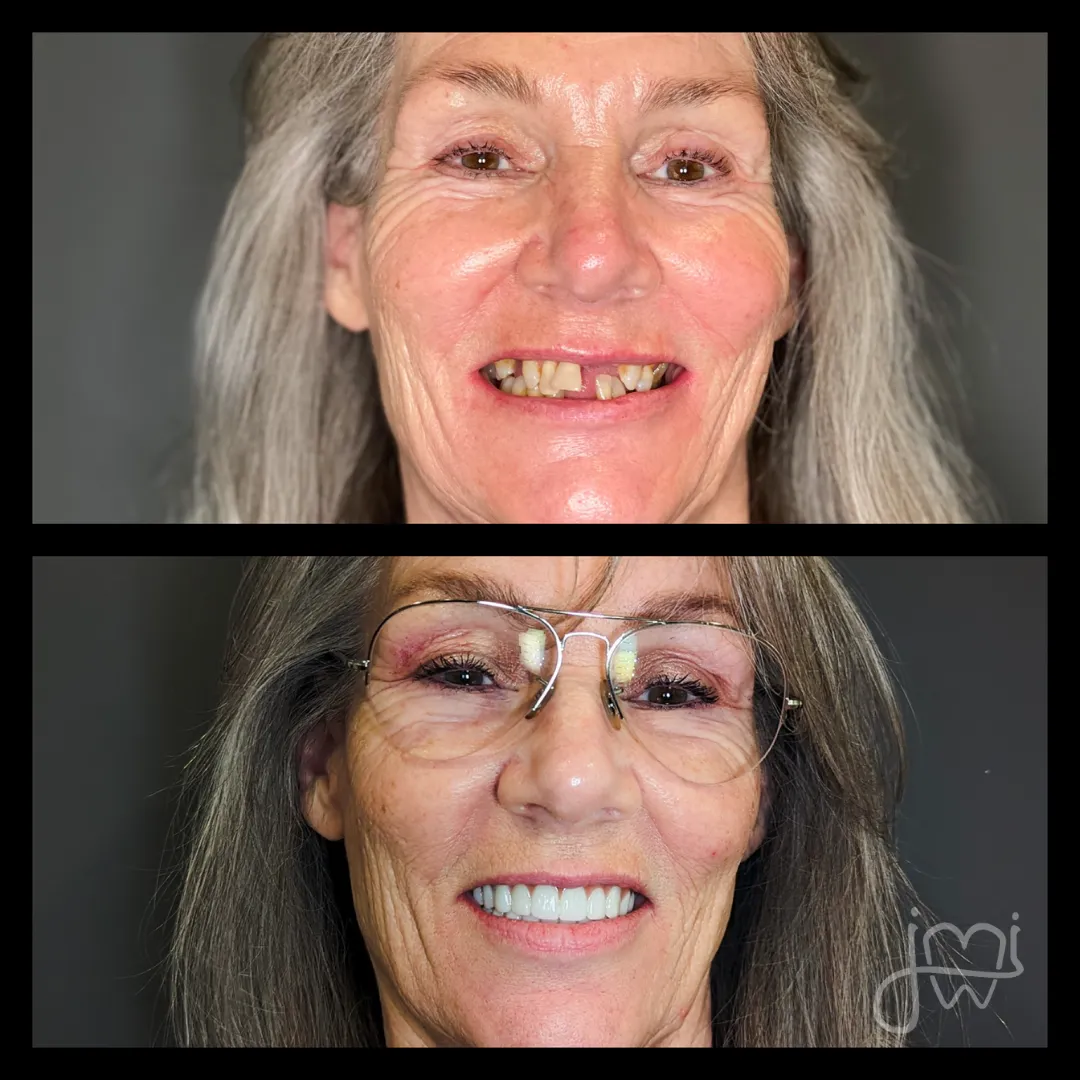 Before and after dental treatment results for a patient at Joshua M. Ignatowicz DMD & Associates