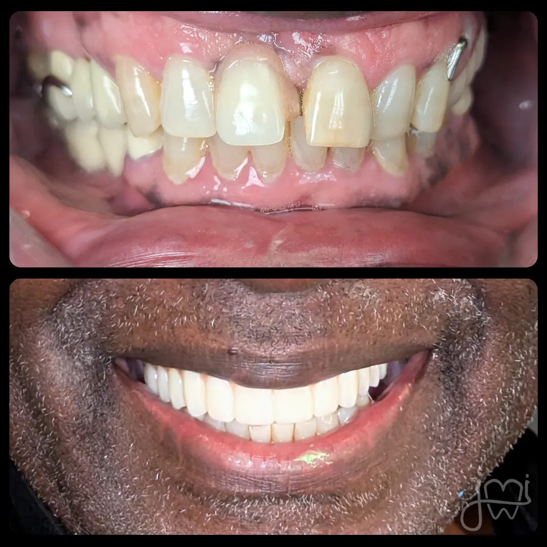 Before and after dental treatment results for a patient at Joshua M. Ignatowicz DMD & Associates
