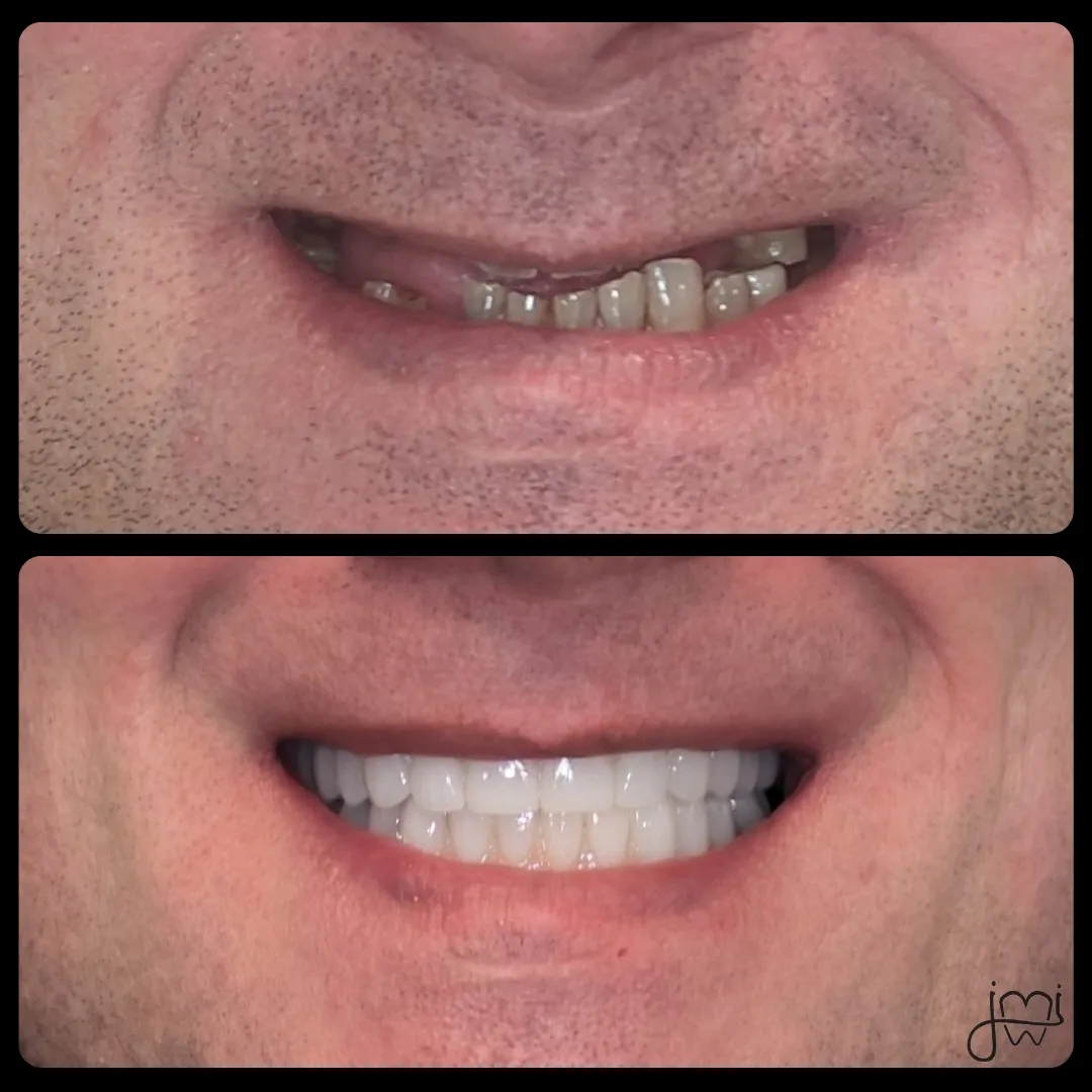 Before and after dental treatment results for a patient at Joshua M. Ignatowicz DMD & Associates