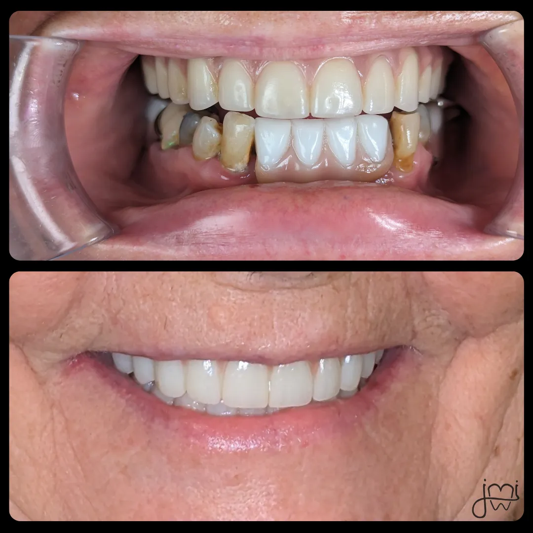 Before and after dental treatment results for a patient at Joshua M. Ignatowicz DMD & Associates