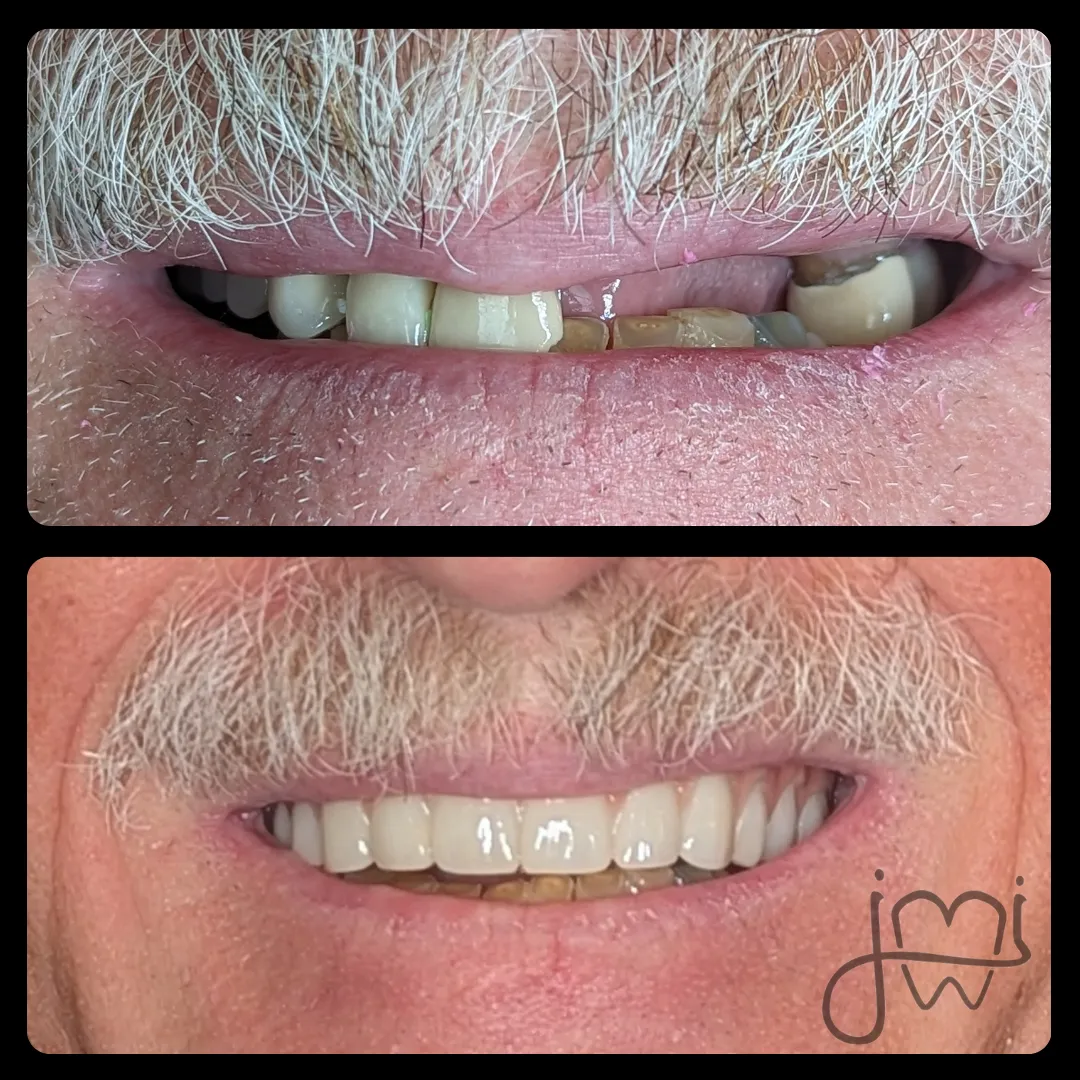 Before and after dental treatment results for a patient at Joshua M. Ignatowicz DMD & Associates