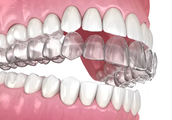 3D illustration of clear aligner trays for orthodontic treatment