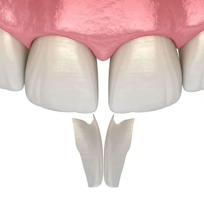 3D illustration of dental bonding applied to the front teeth