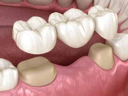 3D illustration of a dental bridge connecting two anchor teeth