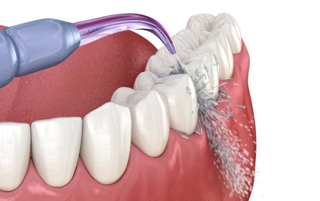 Close up view of a dental cleaning procedure being performed