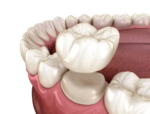 3D illustration of a dental crown placed over a prepared tooth