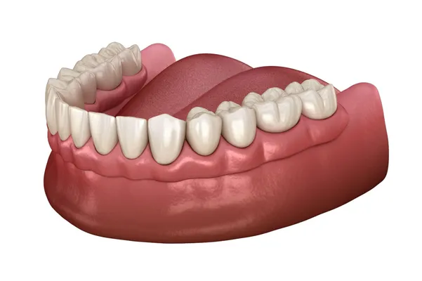 3D illustration of dentures fitted over the lower gum line