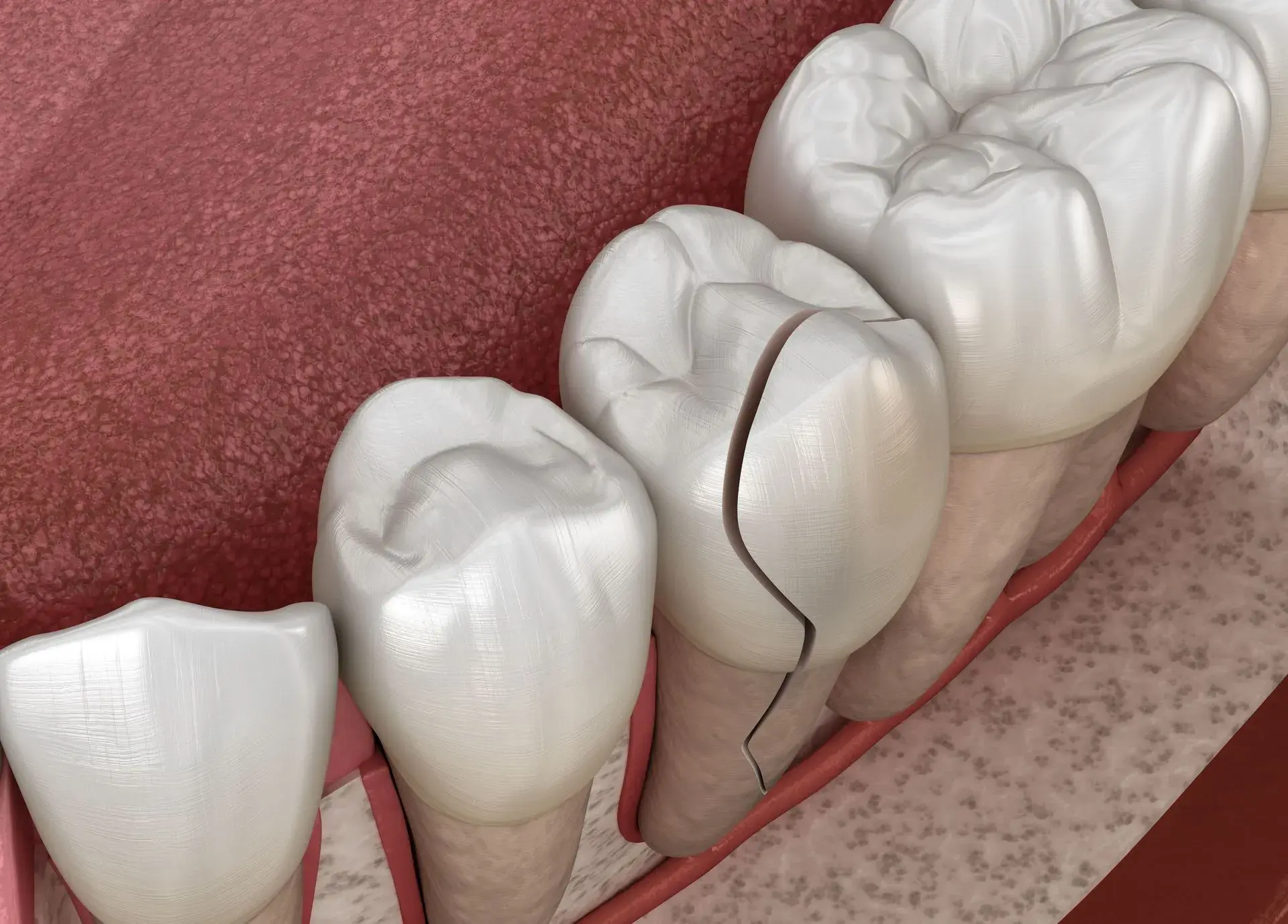 Close-up of upper front teeth showing dental restorations and gum tissue during examination.
