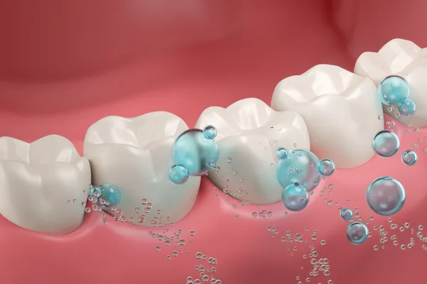 Illustrated close up of teeth receiving fluoride treatment