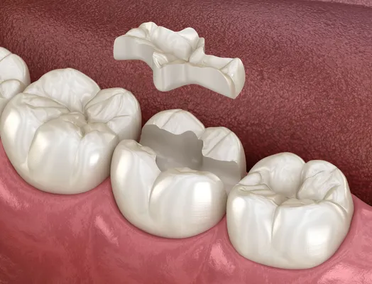 3D illustration of a dental inlay and onlay restoration on a tooth