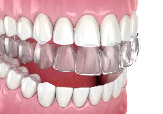 Close up view of a custom fitted mouth guard over teeth