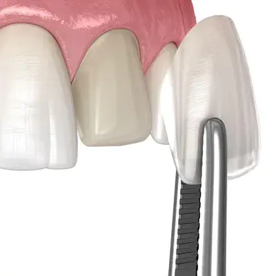 Porcelain veneers being placed on front teeth with dental instrument in Henderson.