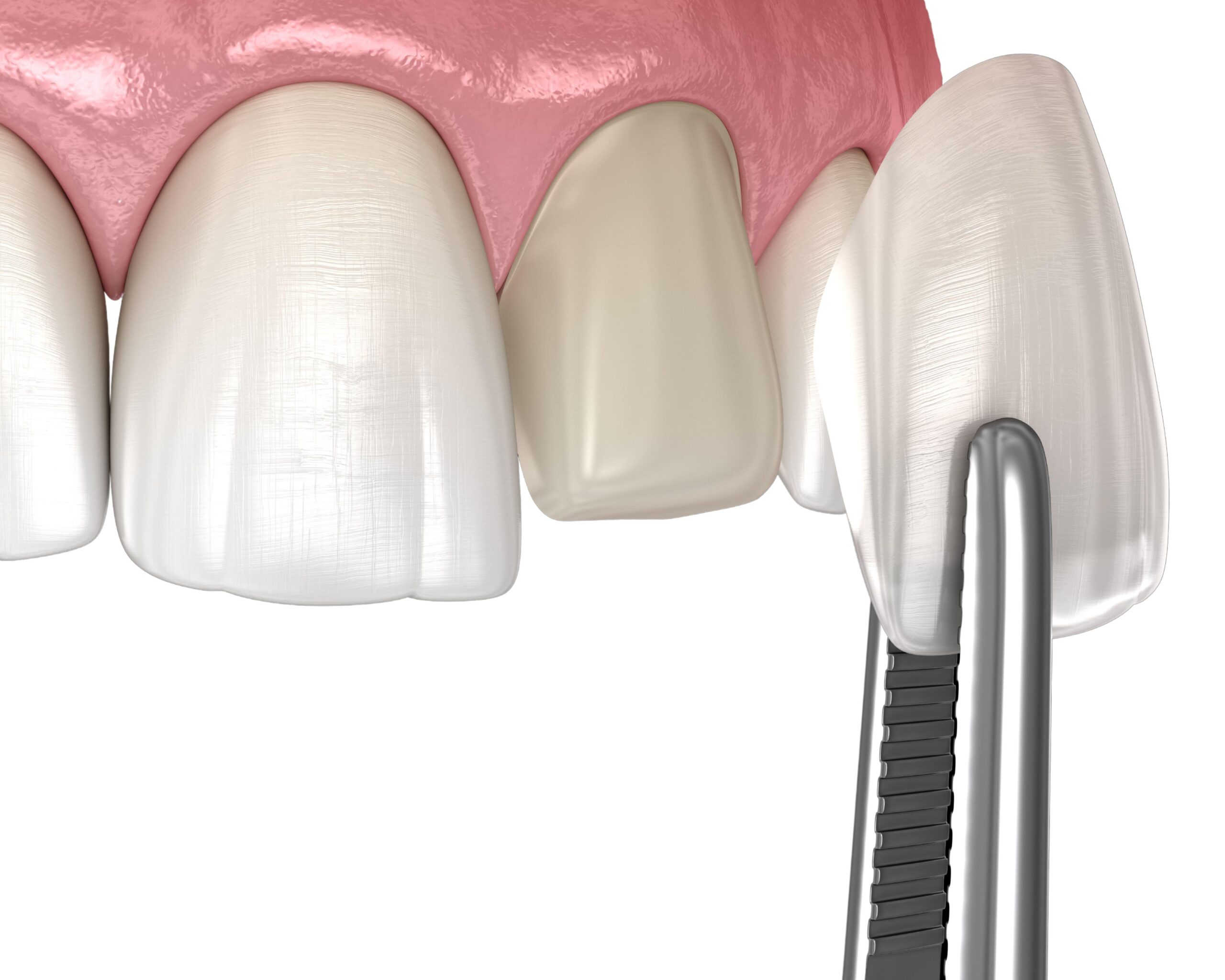 3D illustration of a porcelain veneer being placed on a front tooth