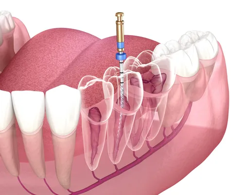 3D illustration of a root canal procedure showing the inner tooth structure